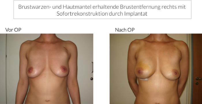 Brustkrebs Behandlung und plastisch-rekonstruktive Operationen an der Brust