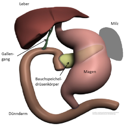 Bauchspeicheldrüsenkrebs Behandlung (Typische Operation bei Pankreaskarzinomen im Kopf der Bauchspeicheldrüse)