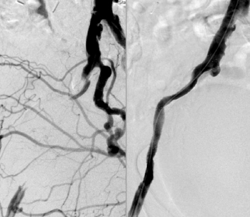 Arteriosklerose Behandlung Durchblutungsstörung am Bein